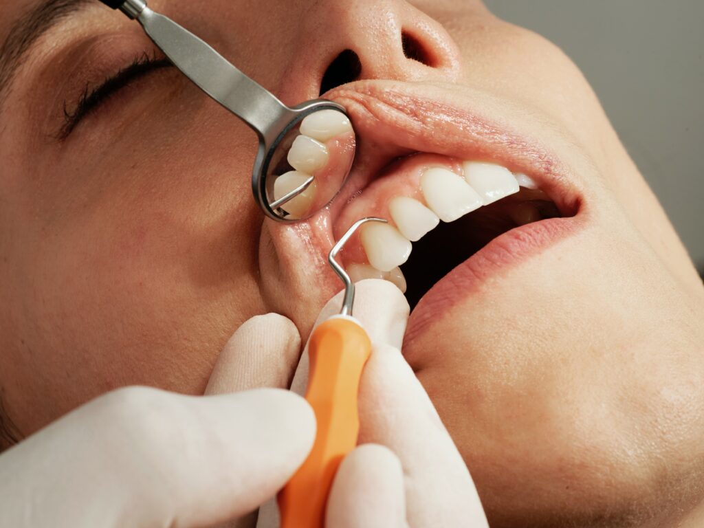 Tandsköterska eller tandhygienist tar bort tandsten.